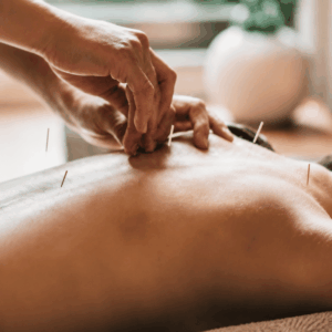 Acupuncture